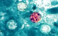 Cyclospora Outbreak in Georgia Reported; No Case Count